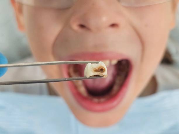 Best Knocked-Out Tooth (Avulsed Tooth) Treatment in Safety Harbor, FL