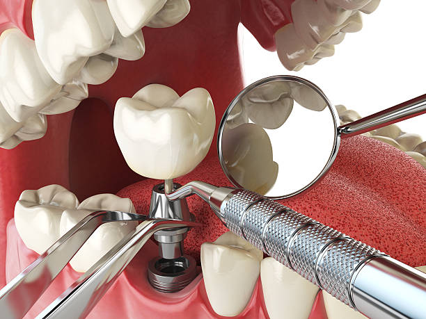 Best Emergency Wisdom Tooth Extraction in Safety Harbor, FL