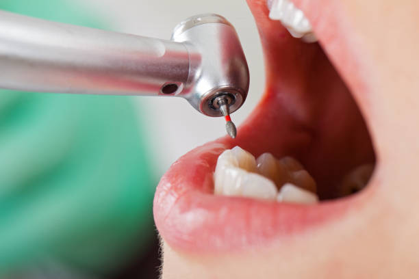 Best Emergency Treatment for Oral Infections in Safety Harbor, FL